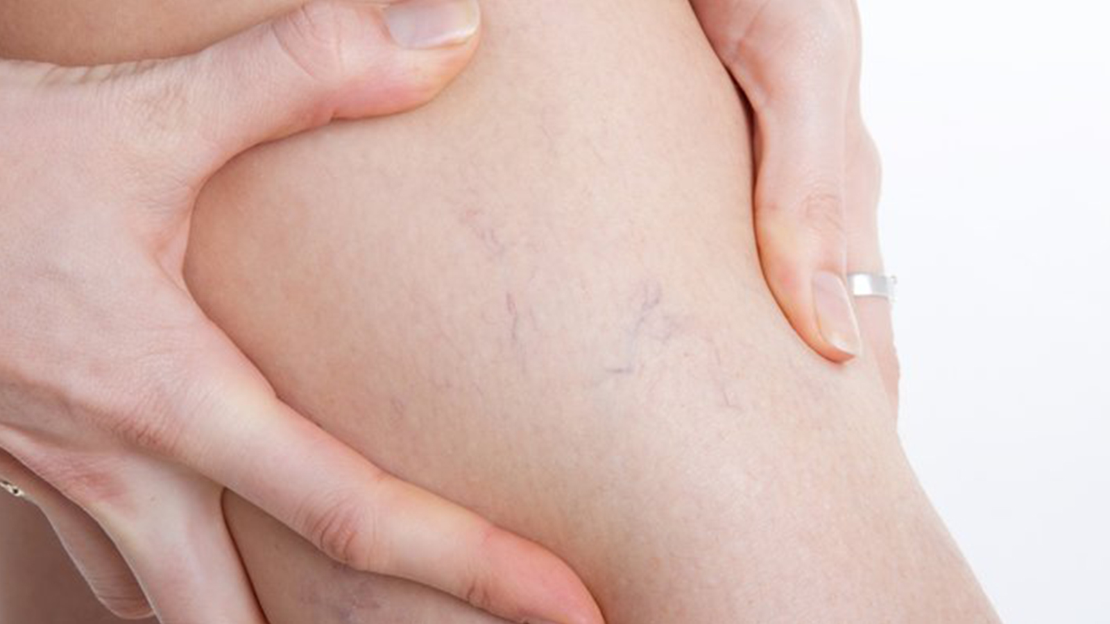 uzmani acikladi varis hastalari sicaklarda nelere dikkat etmeli rwMDx83y