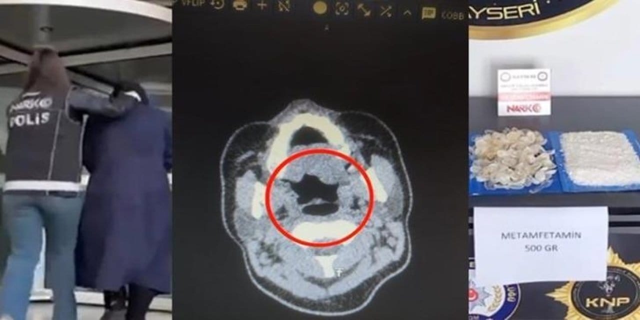doktorlar bile inanamadi midesinden tam 500 gram metamfetamin cikti PGOtqcG6.jpg